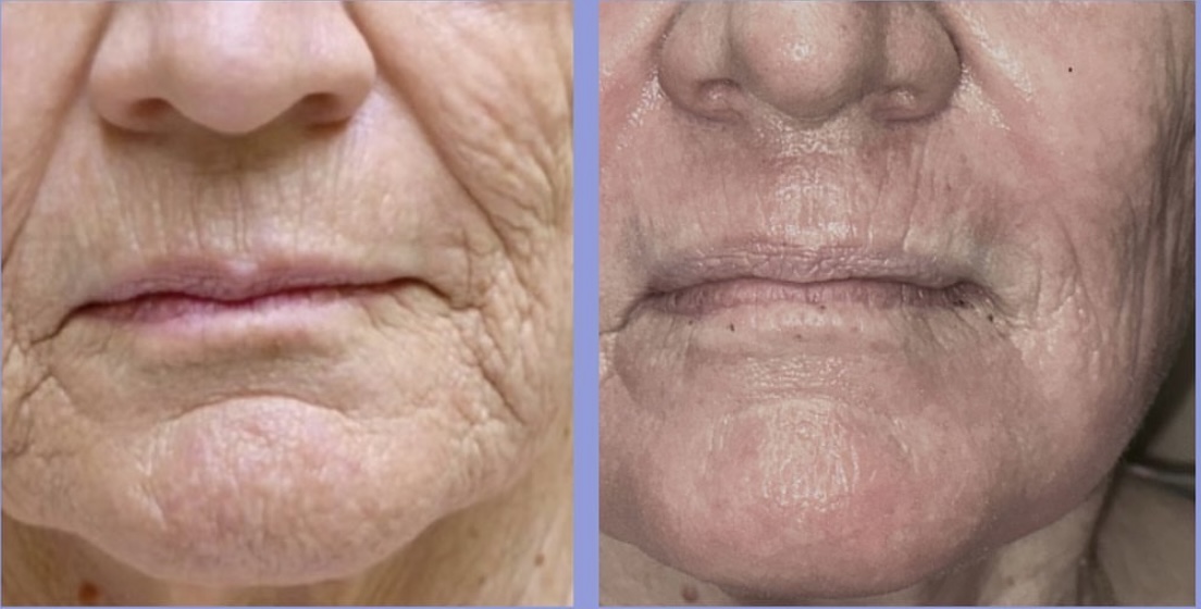 Co2 Ablative Laser Resurfacing Near Me In Boise, Idaho: Frequently Asked Questions 2 CO2 Laser Resurfacing Before and After Blepharoplasty
