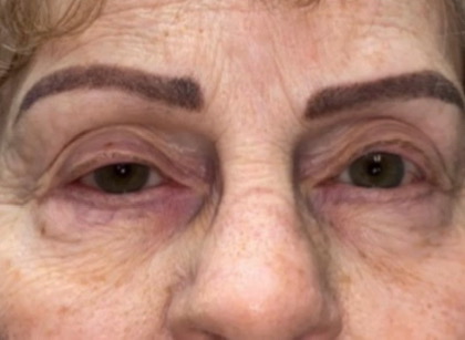 Eyelid Lift (blepharoplasty/ptosis repair)