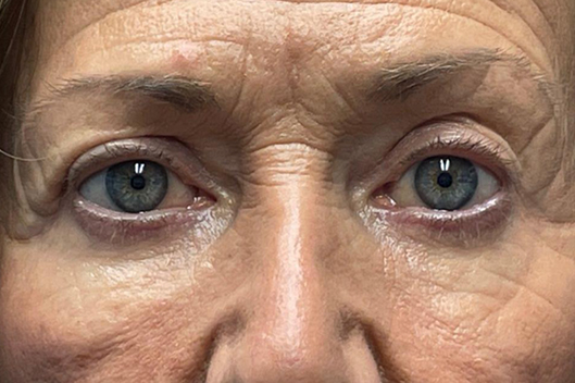 Lower Lid Blepharoplasty (lower eyelid eyelift)
