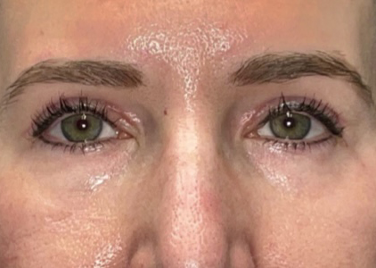 Upper Lid Blepharoplasty (upper eyelid lift)