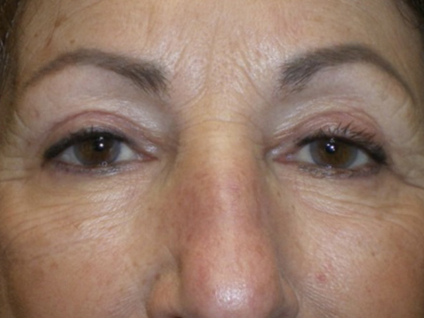 Eyelid Lift (blepharoplasty/ptosis repair)