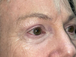 Brow/Forehead Lift