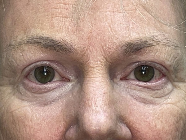 Brow/Forehead Lift