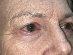 Brow/Forehead Lift