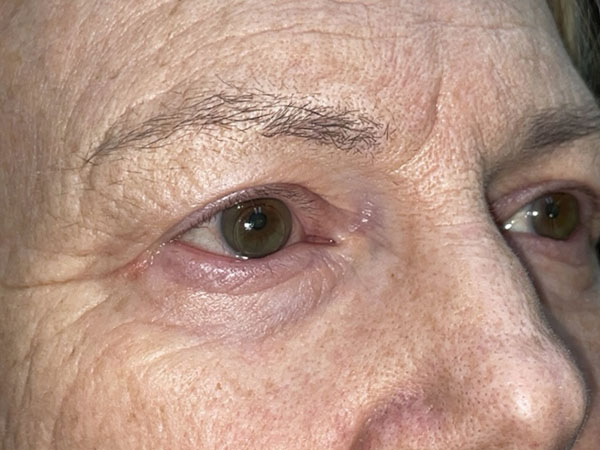 Brow/Forehead Lift