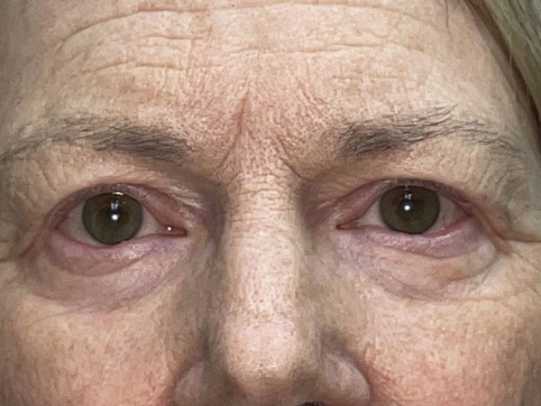 Brow/Forehead Lift