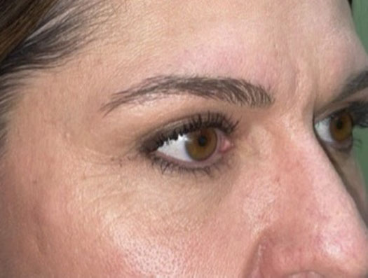 Upper Lid Blepharoplasty (upper eyelid lift)