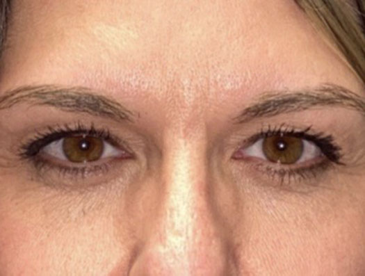 Upper Lid Blepharoplasty (upper eyelid lift)