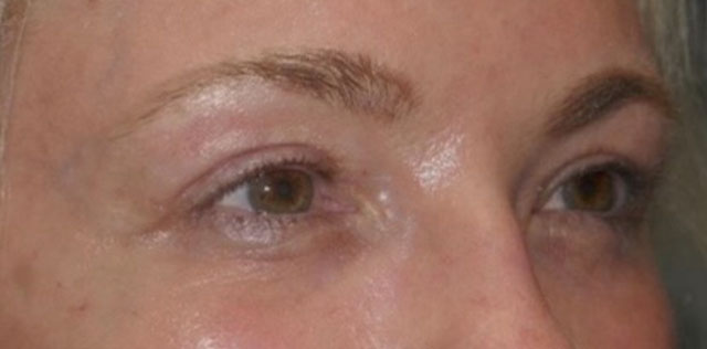 Upper Lid Blepharoplasty (upper eyelid lift)