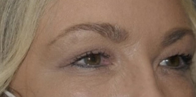 Upper Lid Blepharoplasty (upper eyelid lift)