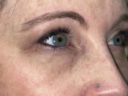 Upper Lid Blepharoplasty (upper eyelid lift)