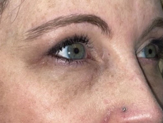 Upper Lid Blepharoplasty (upper eyelid lift)