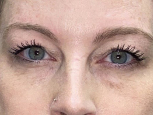 Upper Lid Blepharoplasty (upper eyelid lift)