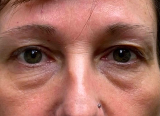 Upper/Lower Lid Blepharoplasty