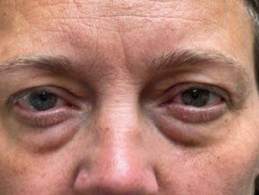 Upper/Lower Lid Blepharoplasty