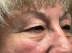 Eyelid Lift (Blepharoplasty/Ptosis Repair)