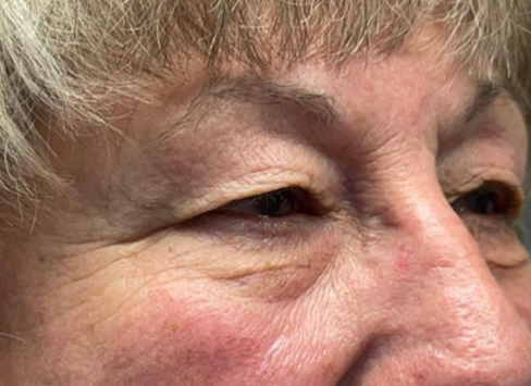 Eyelid Lift (Blepharoplasty/Ptosis Repair)
