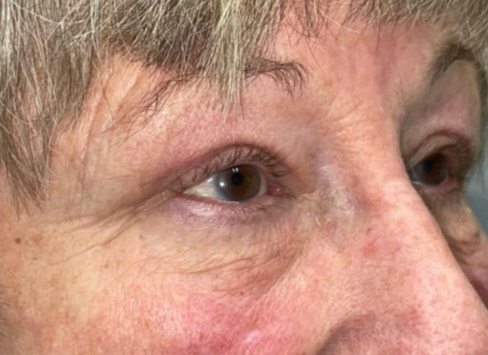 Eyelid Lift (Blepharoplasty/Ptosis Repair)