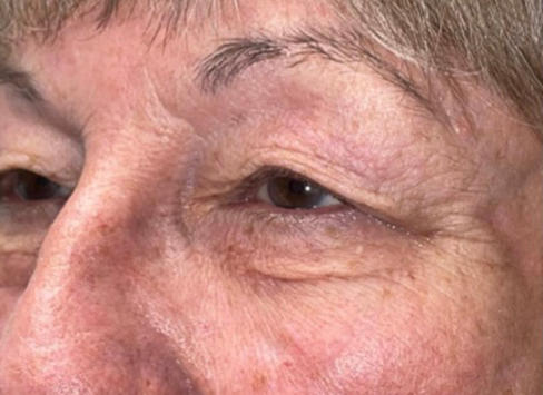 Eyelid Lift (Blepharoplasty/Ptosis Repair)