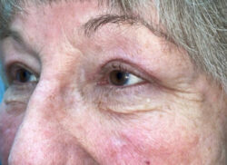 Eyelid Lift (Blepharoplasty/Ptosis Repair)