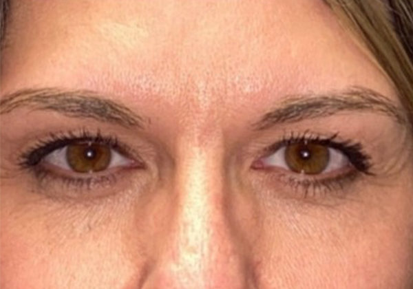 Upper Lid Blepharoplasty (upper eyelid lift)
