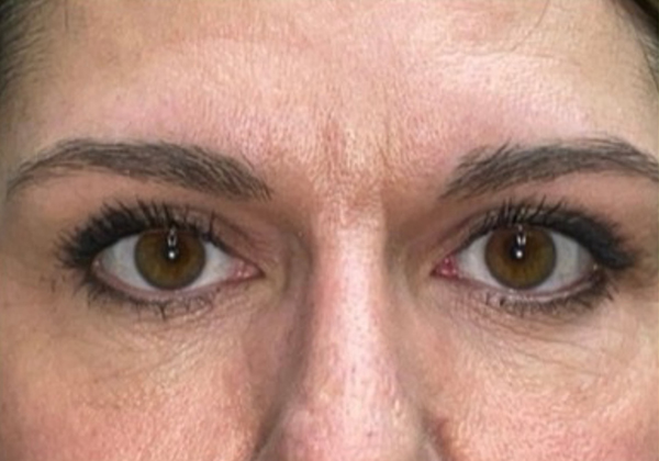 Upper Lid Blepharoplasty (upper eyelid lift)
