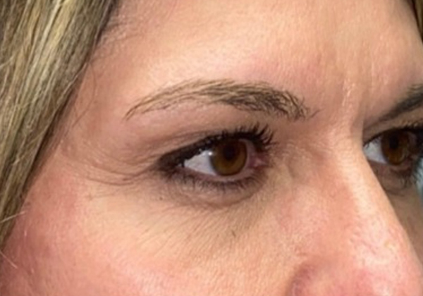 Upper Lid Blepharoplasty (upper eyelid lift)
