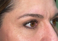 Upper Lid Blepharoplasty (upper eyelid lift)