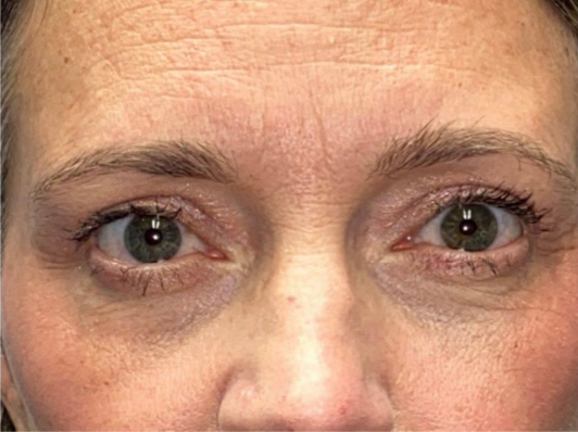 Upper/Lower Lid Blepharoplasty