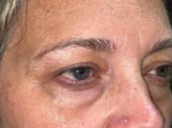 Upper/Lower Lid Blepharoplasty