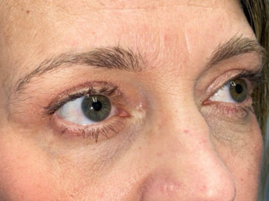 Upper/Lower Lid Blepharoplasty
