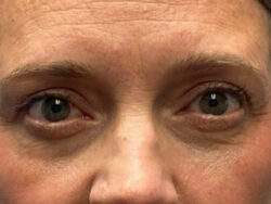 Upper/Lower Lid Blepharoplasty