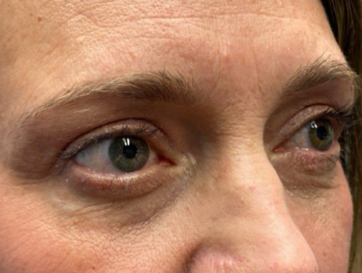 Upper/Lower Lid Blepharoplasty
