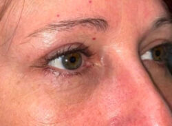 Upper/Lower Lid Blepharoplasty
