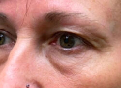 Upper/Lower Lid Blepharoplasty