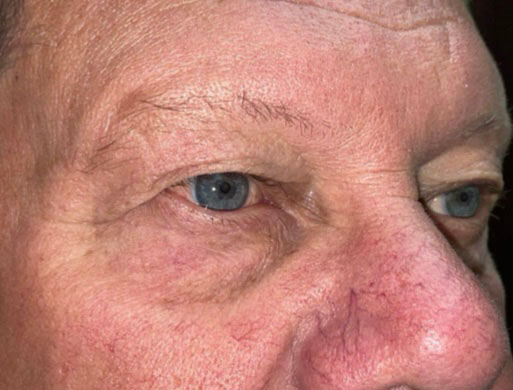 Eyelid Lift (Blepharoplasty/Ptosis Repair)