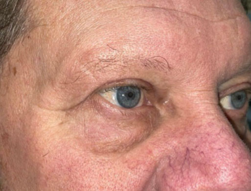 Eyelid Lift (Blepharoplasty/Ptosis Repair)