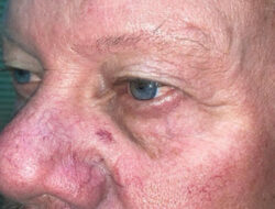 Eyelid Lift (Blepharoplasty/Ptosis Repair)