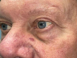 Eyelid Lift (Blepharoplasty/Ptosis Repair)