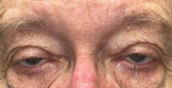 Eyelid Lift (Blepharoplasty/Ptosis Repair)