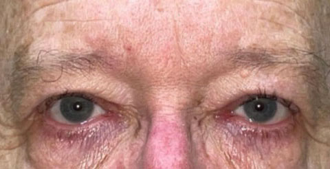 Eyelid Lift (Blepharoplasty/Ptosis Repair)