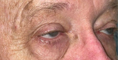Eyelid Lift (Blepharoplasty/Ptosis Repair)