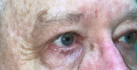 Eyelid Lift (Blepharoplasty/Ptosis Repair)