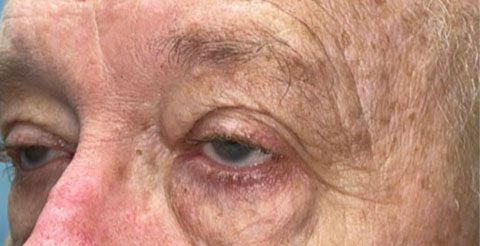 Eyelid Lift (Blepharoplasty/Ptosis Repair)