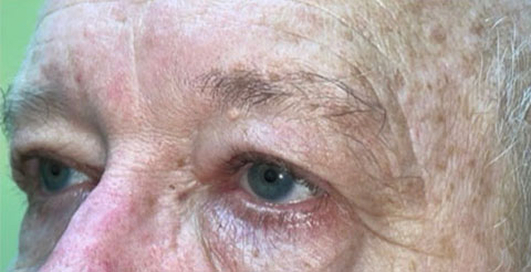 Eyelid Lift (Blepharoplasty/Ptosis Repair)