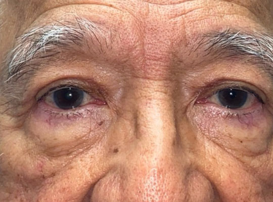 Eyelid Lift (blepharoplasty/ptosis repair)