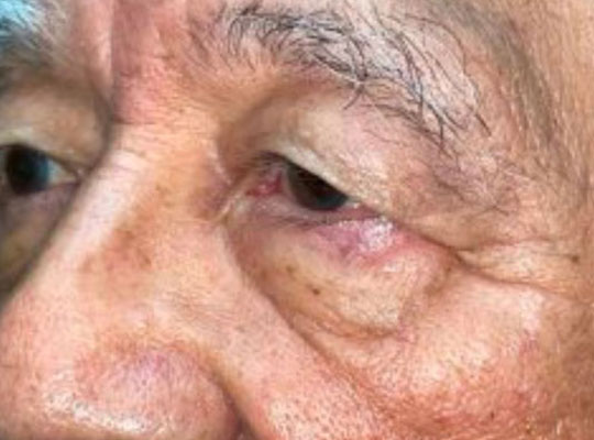 Eyelid Lift (blepharoplasty/ptosis repair)