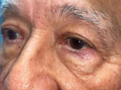 Eyelid Lift (blepharoplasty/ptosis repair)