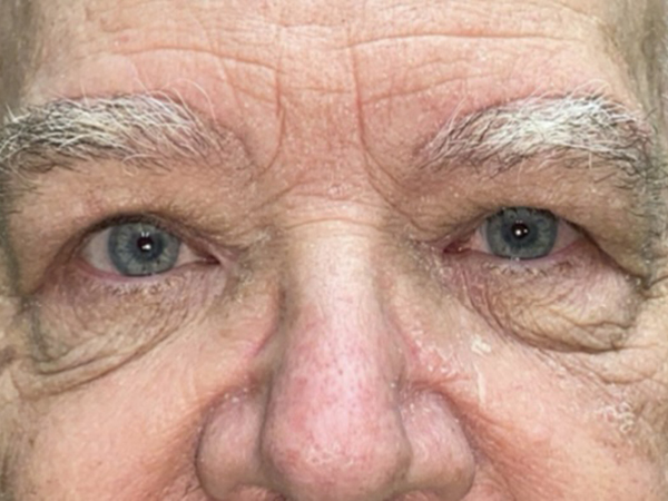 Brow/Forehead Lift