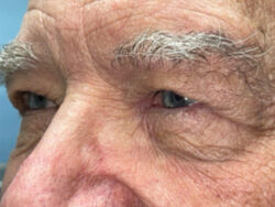 Brow/Forehead Lift